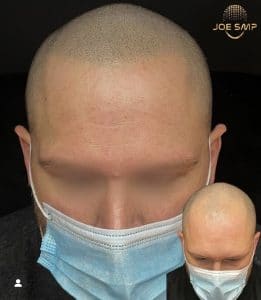 scalp micropigmentation before and afters